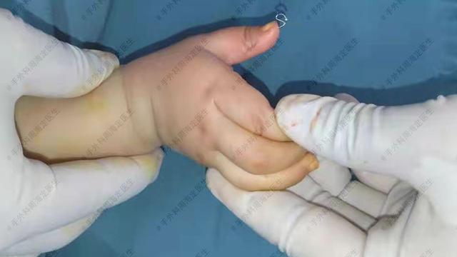 宝宝多指手术后，手上固定的克氏针什么时候才能取下来