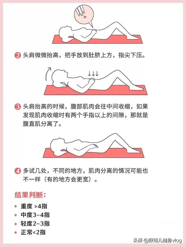 虐腹先修復——腹直肌分離大解析 健身減肥達人 第3张