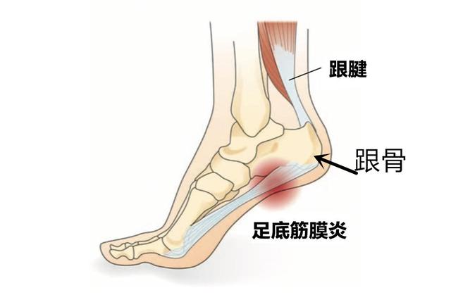 足底疼痛位置图，脚底疼痛部位图解（足跟痛是什么？要怎样预防）