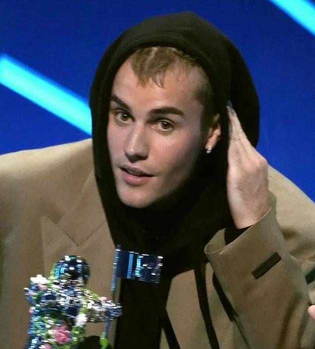 Justin Bieber Seborrheic Alopecia There Are Signs Of Baldness Luju Bar