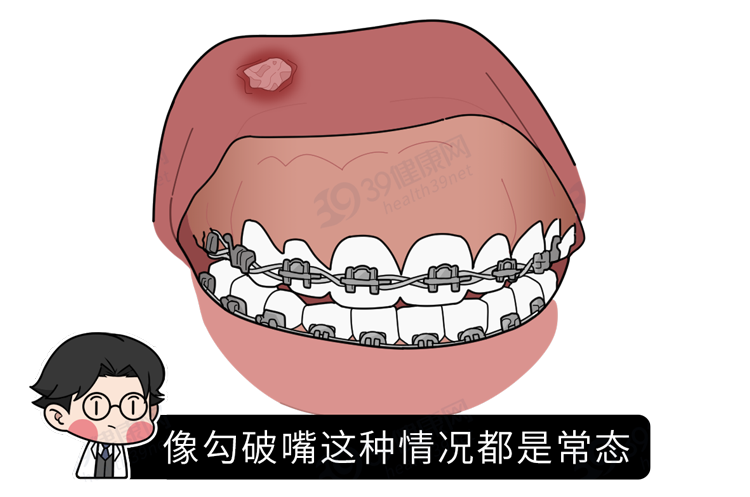 为什么只要戴牙套,牙齿就可以恢复得很整齐?生动展示矫正过程