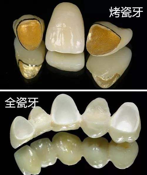 即烤瓷熔附金属全冠,简单来说,就是医生在做牙体修复时,利用特殊材料