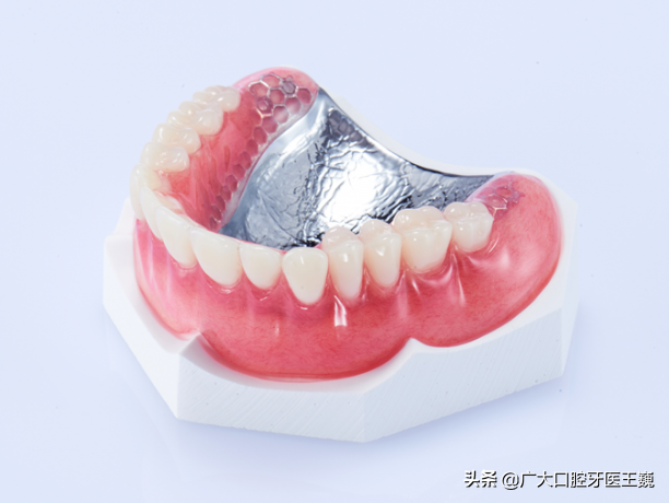 口内留有残存牙齿的可选局部活动义齿.