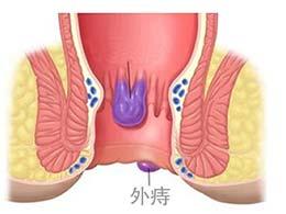 怎么判断痔疮还是息肉肛门长肉疙瘩是痔疮