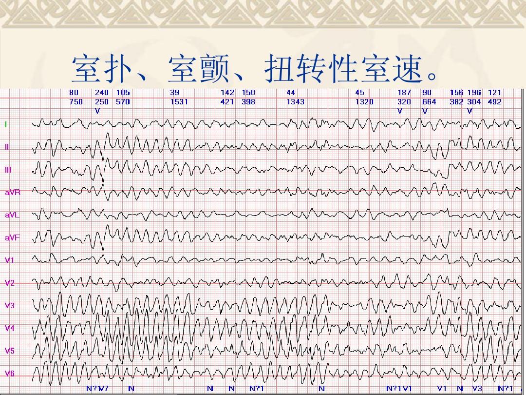 二,室速或室颤(这里要说明,心肌梗死分为两种,这种心电图能马上诊断的