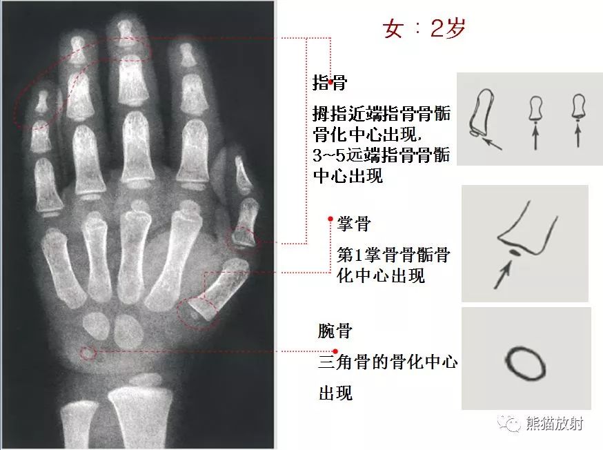 骨龄对照表,骨龄对照表10到16岁