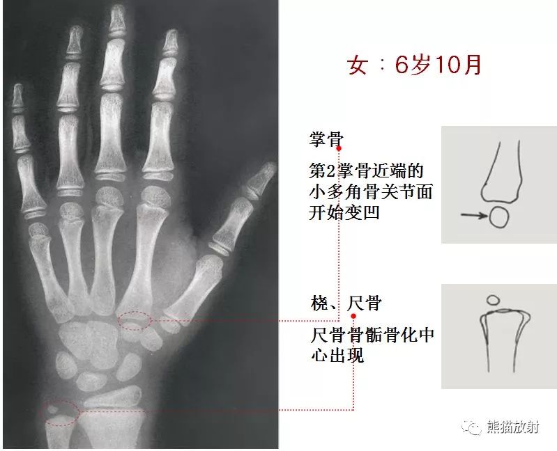 骨龄对照表骨龄对照表10到16岁