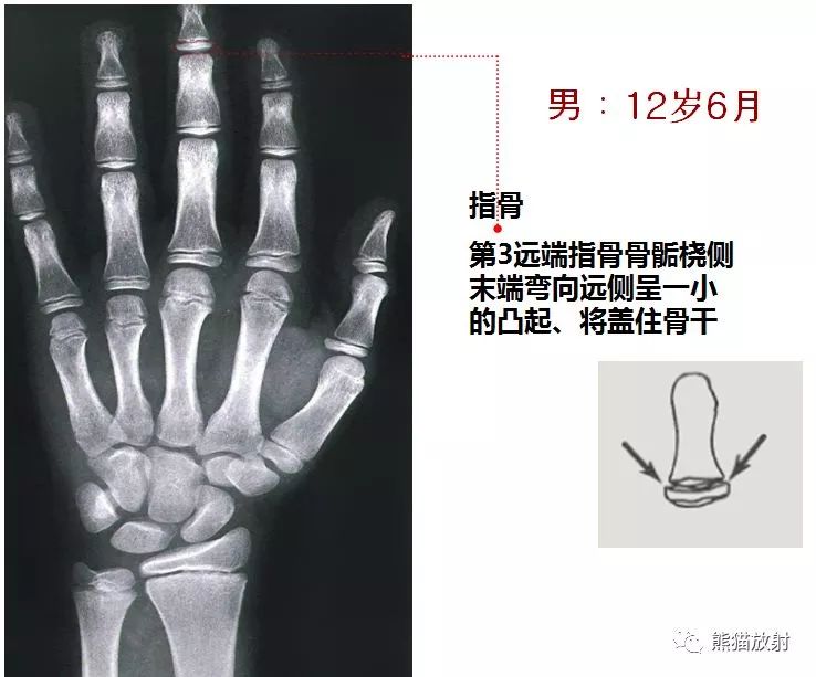 骨龄对照表,骨龄对照表10到16岁