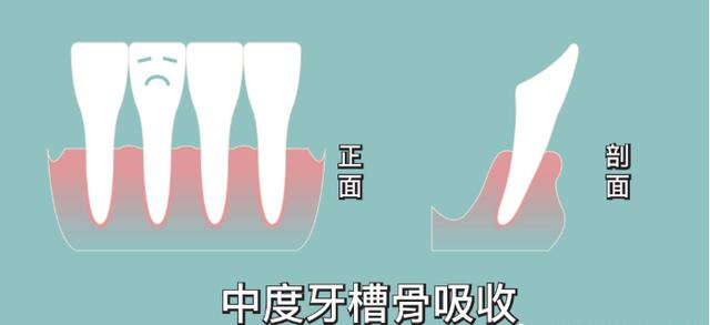 牙槽骨吸收可以恢复吗儿童牙槽骨吸收可以恢复吗