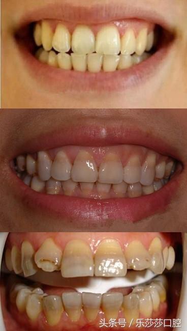 如去甲金霉素使牙齿呈黄色,金霉素使牙呈灰棕色,土霉素使牙齿呈浅黄色