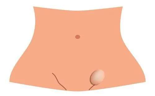 孩子身上出现的小鼓包，情节严重可影响生育！