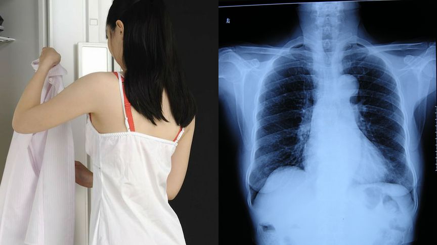 女孩拍x光被要求脱光上衣医生停职来检查没男女之分