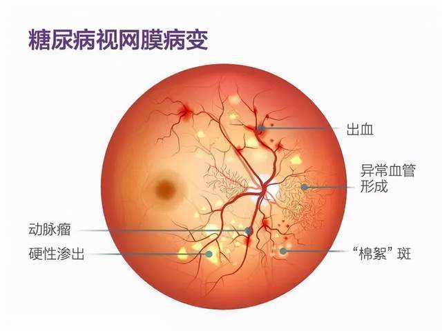 开封市人民医院 糖尿病视网膜病变小课堂 中州融媒网