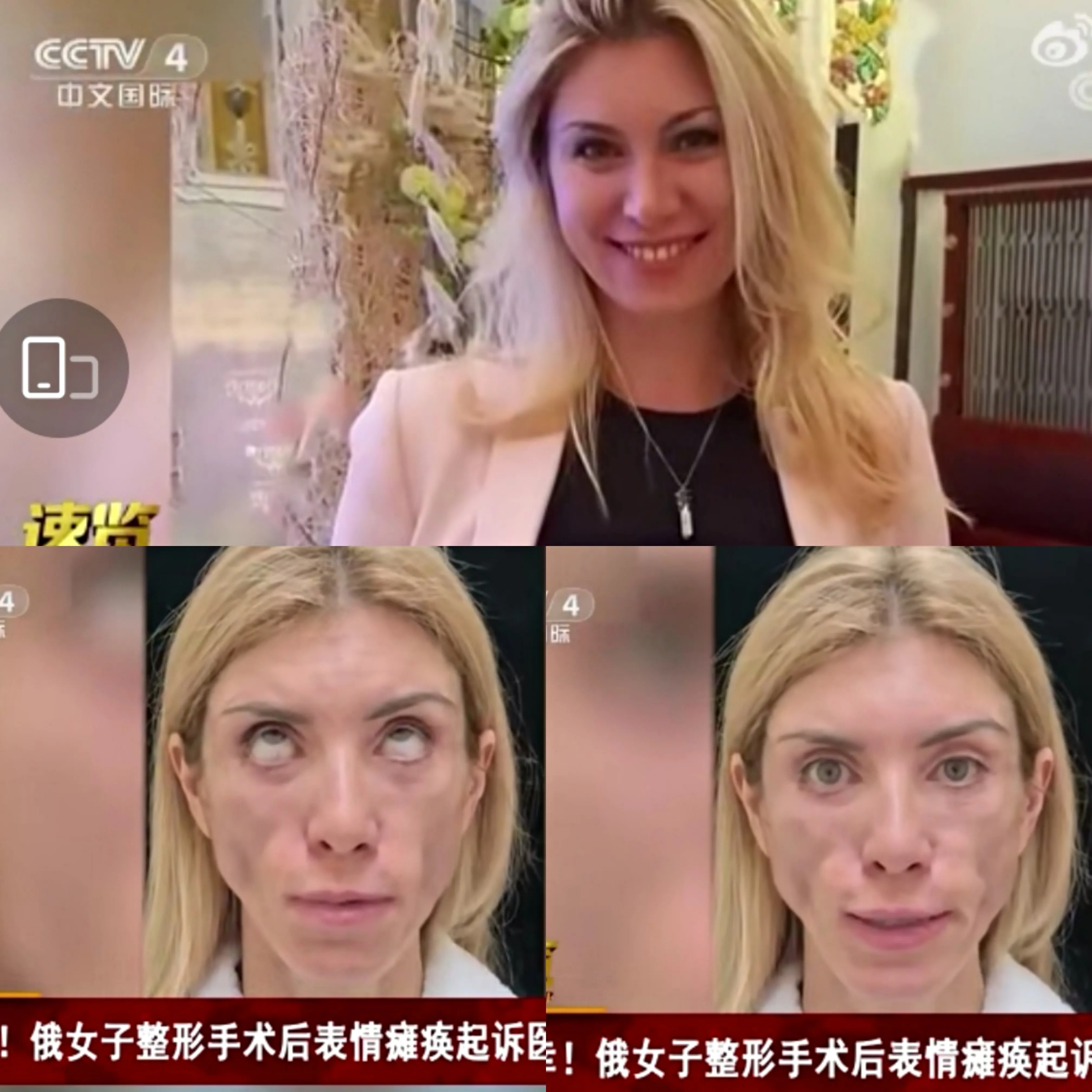 近日，来自我罗斯索契的一女子，整形后表情瘫痪(图1)