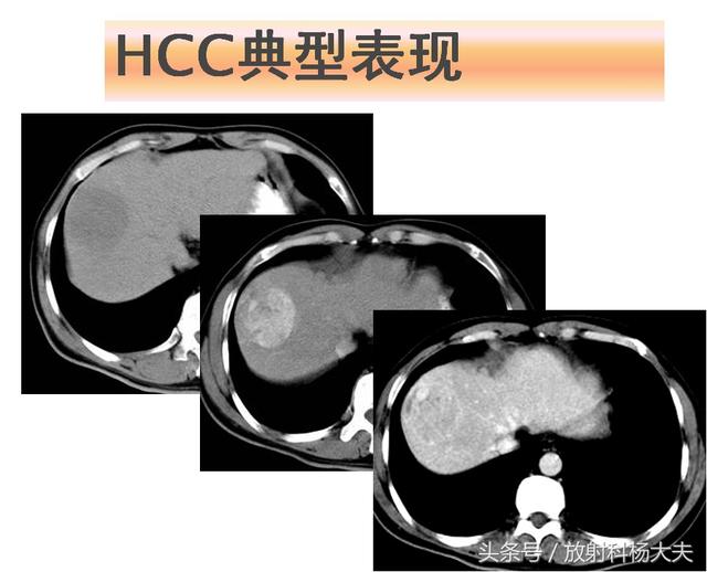 肝脏检查示高分化hcc什么意思