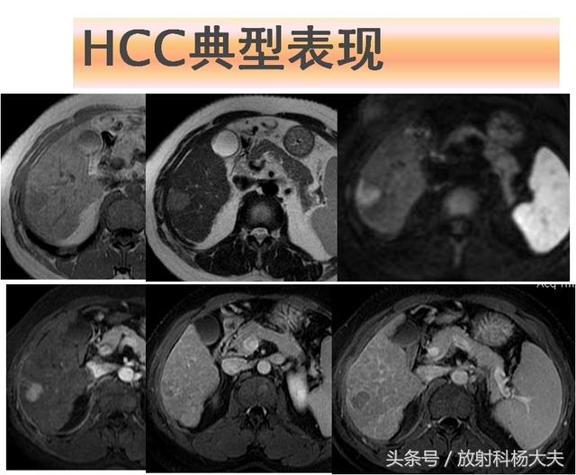 肝脏检查示高分化hcc什么意思