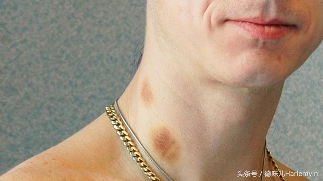 吻痕怎么快速消除