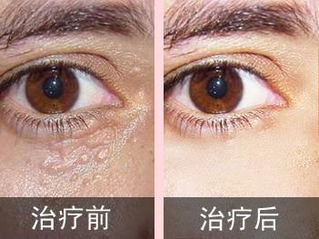 眼睛下汗管瘤怎么治疗眼睛下边汗管瘤怎么治疗