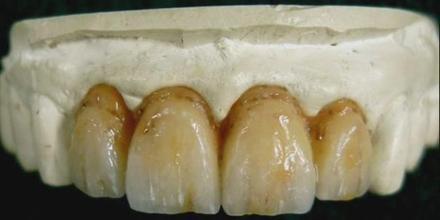 然而,当你一口氟斑牙的时候,你还敢开怀大笑吗?