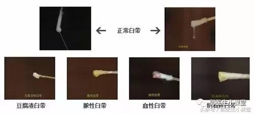 白带检查的杂菌加一是什么意思