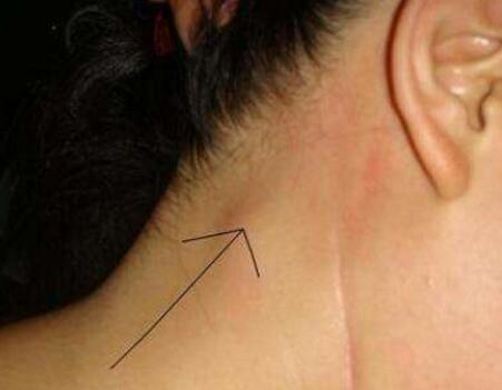 恶性淋巴瘤的症状_健康症状网