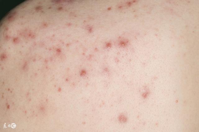 掌角化性鳞屑性红斑