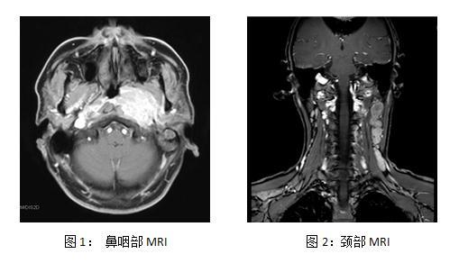鼻咽癌非角化性未分化型治愈