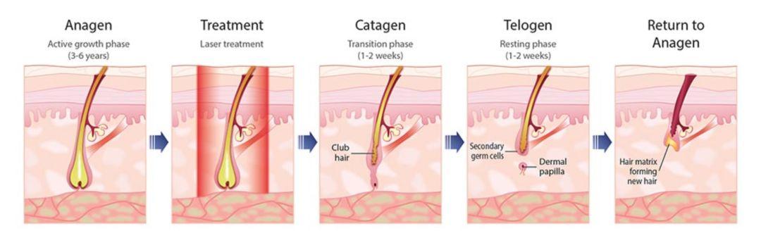 脱毛仪后毛周角化