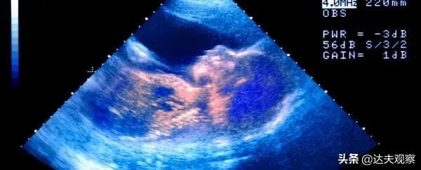 胎儿在子宫里会哭？超声波发现奇怪现象：或在出生前练习“哭泣”