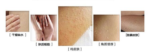为什么手臂上突然长鸡皮疙瘩