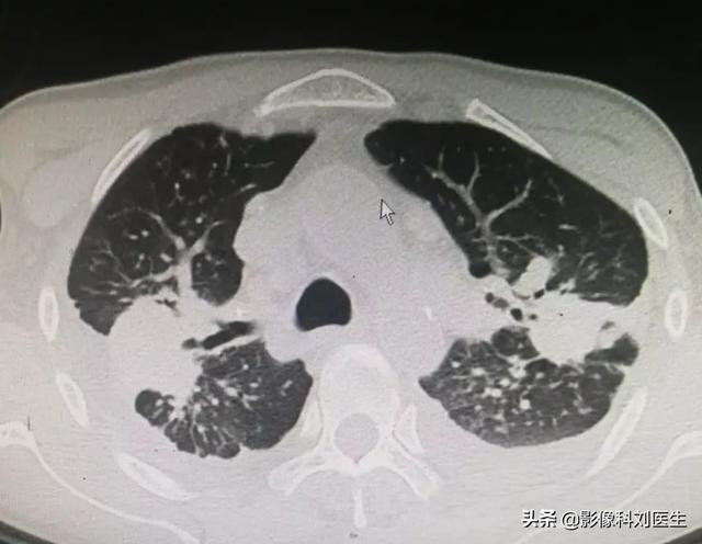 一期尘肺高清影像图片图片