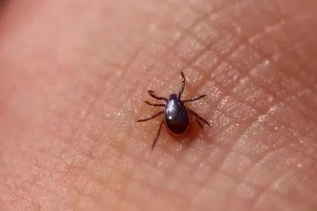 落基山斑疹热由蜱虫叮咬,立克次氏体感染引起,具有潜在的致命性