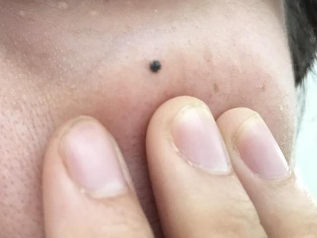 黑色素瘤和脂溢性角化病的区别