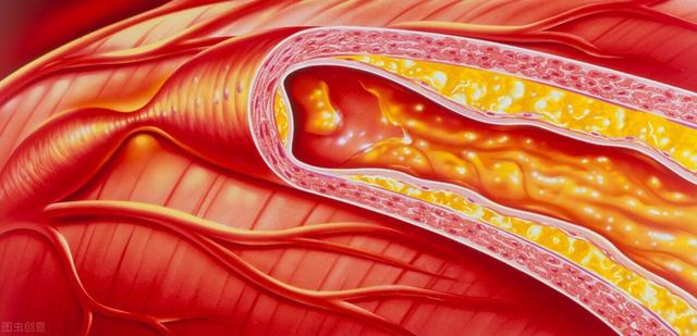 60多岁后每年需要“冲”血管？这个误区，现在还有很多老人在做