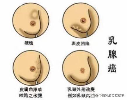 乳腺癌患者中晚期，該如何用藥？