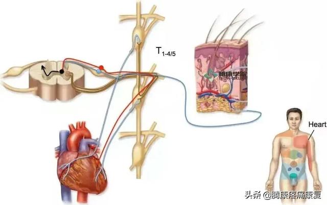 神经根炎