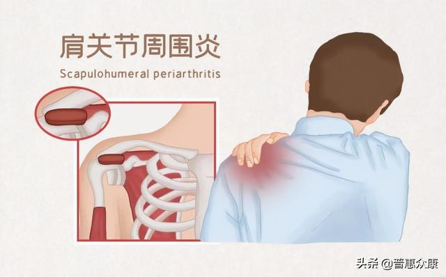 日渐年轻化的“肩周炎”该怎么治？《人体解锁》缓解自救指南