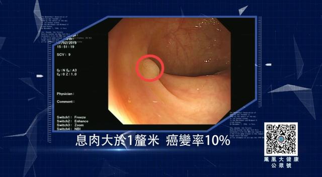 肠癌怎么办