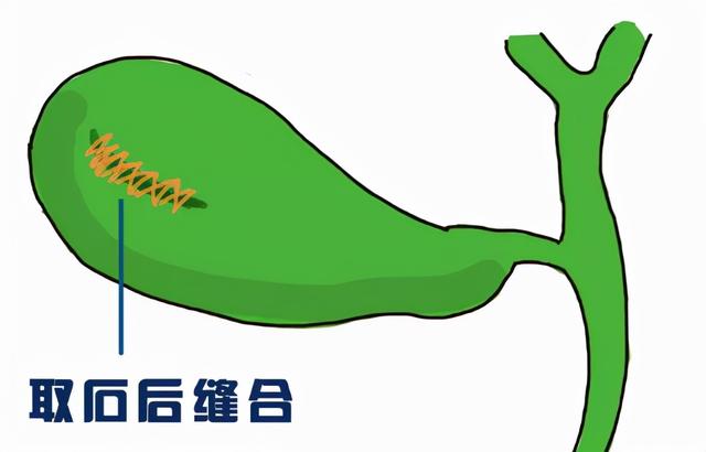 “冬季到，胆结石闹”那么治疗胆结石到底是切还是保？