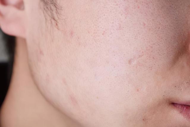 青春期鸡皮肤很严重