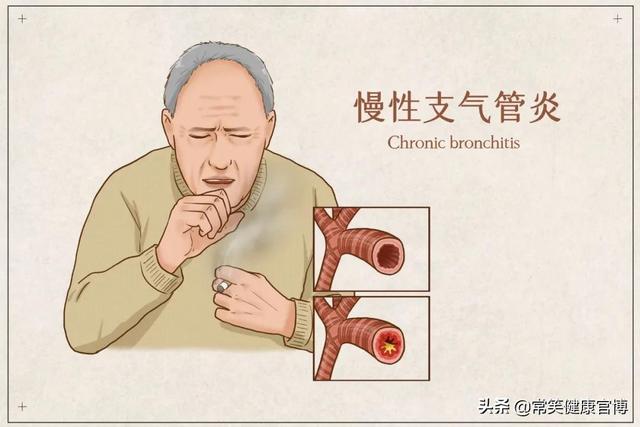 慢性支气管炎危害大，如何正确预防呢？
