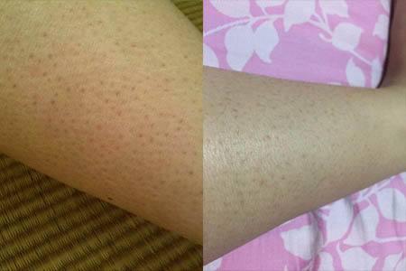 毛囊过度角化飞行员