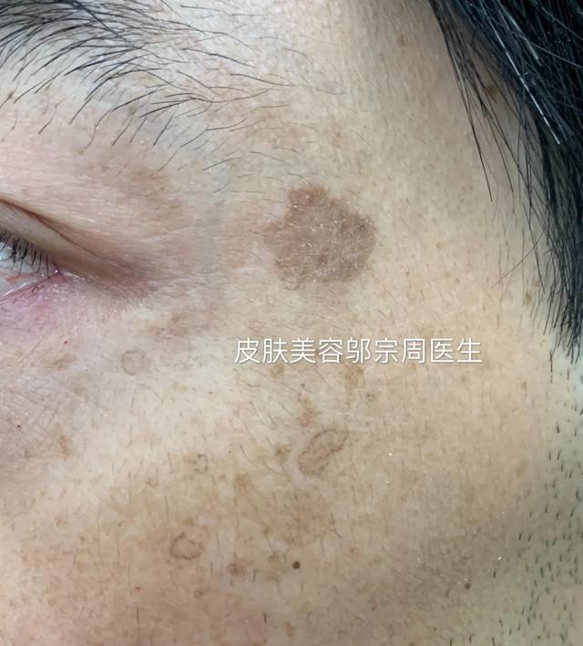 汗孔角化症会越长越多吗