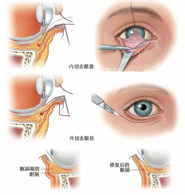 去眼袋最有效的方法图片