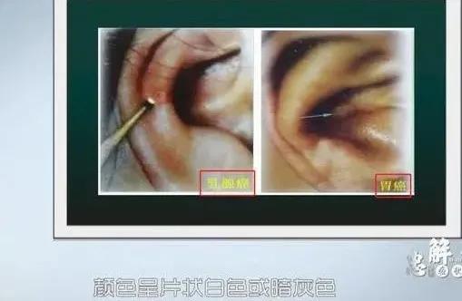 醫生提醒：癌變前，耳朵舌頭會“求救”！厚白苔肺癌，肝癭線肝癌