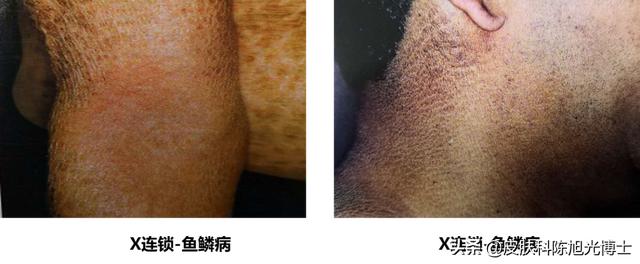 掌趾角化遗传方式