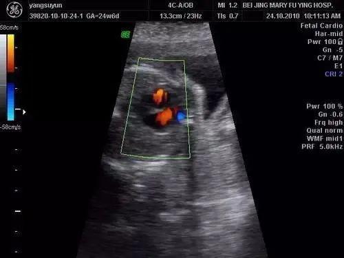 查出胎儿心室强光点好怕怕