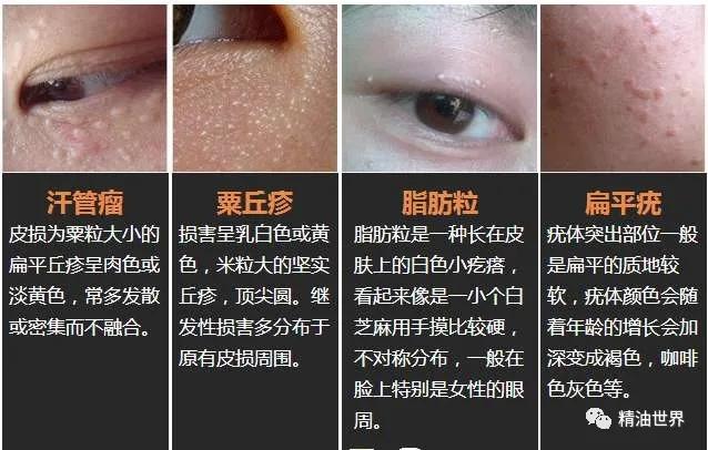 脂肪粒挑破疼吗脂肪粒挑了还会长