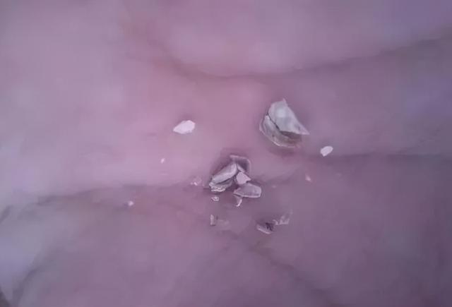 洗牙大概要多少钱（洗牙普通200深度3000，有什么区别）