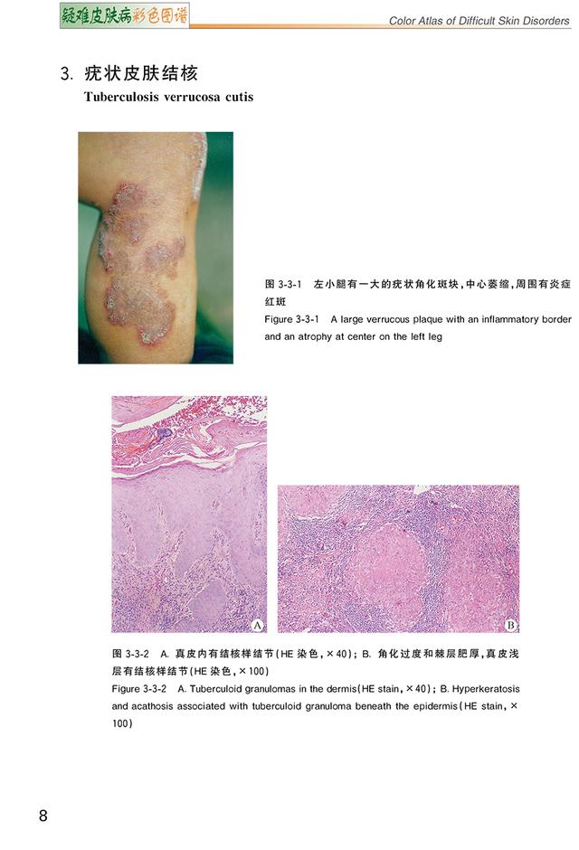 肢端角化弹力纤维鉴别